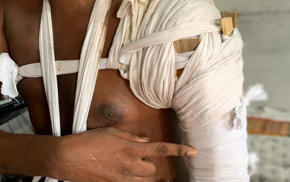 Le bras gauche du pasteur Ramesh est enveloppé par un épais bandage qui va de l’avant-bras jusqu’à l’épaule.