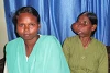 Urmila Digal avec sa fille Rashmita Pradhan (24 ans). Son visage était complètement déformé par la tumeur maligne. (csi)