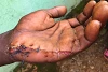 La main de Jerry a été grièvement blessée lors d’une attaque des milices peules. (csi)
