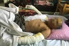 Tejal (nom fictif) a été blessé par huit éclats de bombes et a subi des brulures au visage et aux bras. Il faudra encore beaucoup de temps jusqu’à ce qu’il soit rétabli. CSI participe aux frais médicaux. (mad)
